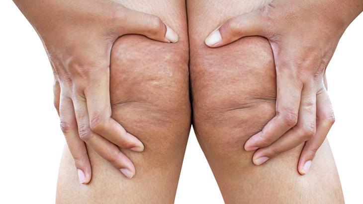 lipodem kadinlarin sessiz cigligi neden kilo veremiyorum diyenler icin cevap VEfudJeu.jpg